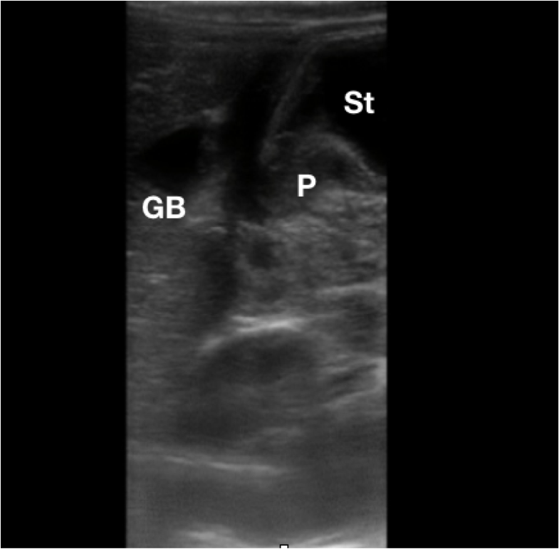 Figure 2.  Sonographic anatomy of the pylorus (P) in relation to the gallbladder (GB) and stomach (St).png