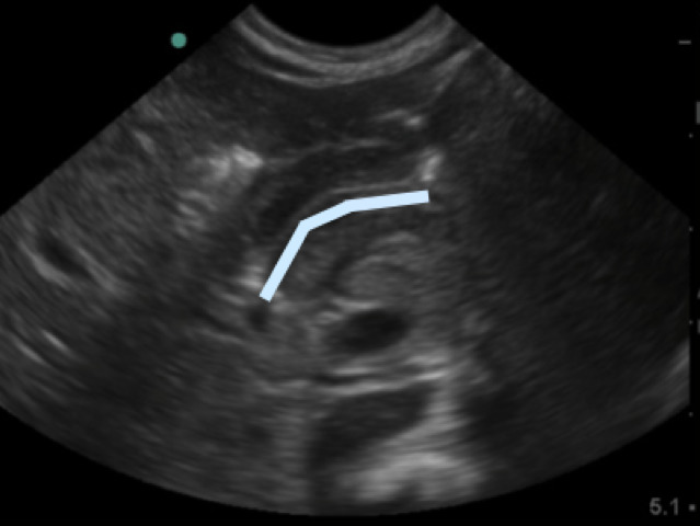 Figure 4b.  Highlighted pyloric channel made up of gastric mucosa.jpg