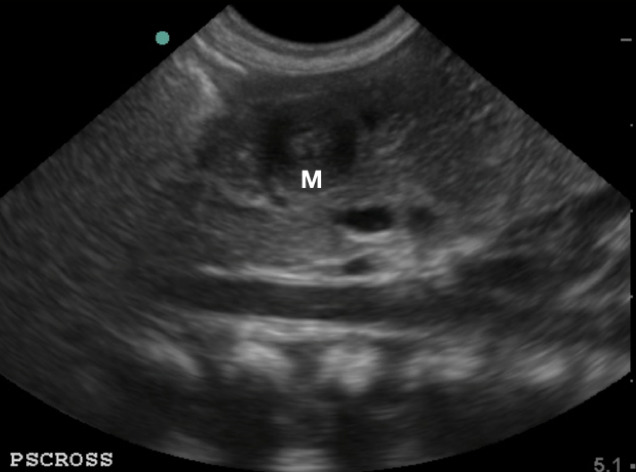 Figure 5.  Pylorus in short axis_ transverse view, the &ldquo;target sign&rdquo; (M_ pylorus muscle).jpg