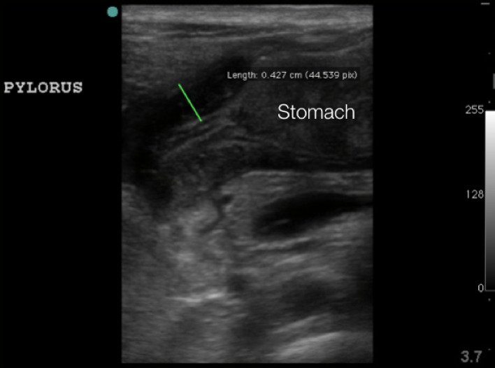 Figure 6.  Hypertrophied pyloric muscle in long axis measuring 4.3mm.jpg