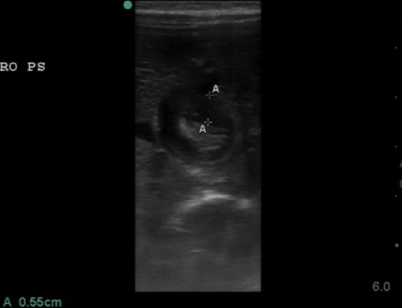 Figure 7.  Hypertrophied pyloric muscle in short axis measuring 5.5mm.jpg