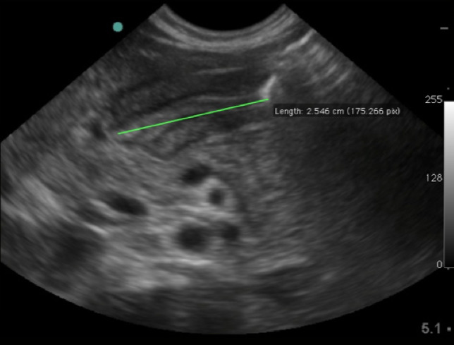 Figure 8.   Elongated pyloric channel (25mm) consistent with stenosis.jpg