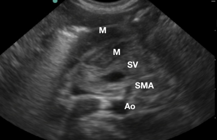 Figure 3  Sonographic anatomy of the pyloric muscle  .JPG