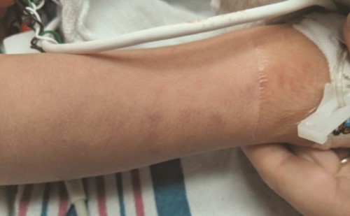 Figure 1: Right upper extremity on presentation. Figure 1