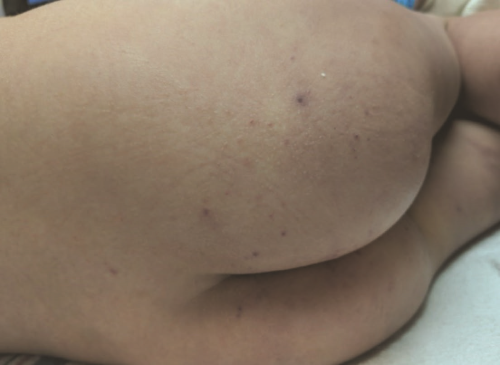 figure 2 Figure 2: Gluteal rash on presentation.