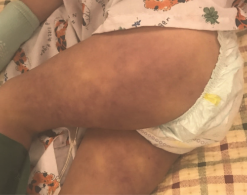 Figure 3 Figure 3: Bilateral lower extremity rash 3 hours after initial presentation.