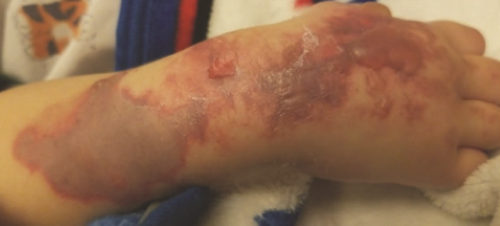 Figure 4 Figure 4: Right upper extremity, day 4 of admission.