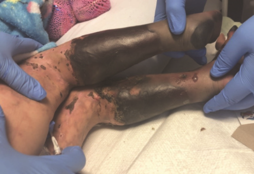 Figure 6 Figure 6: Bilateral lower extremities, day 18 of admission.