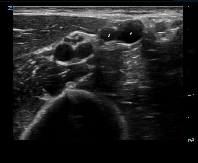 Figure 1. Short axis peripheral.png