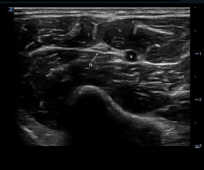 Figure 3. Nerve adjacent to a vessel.jpeg