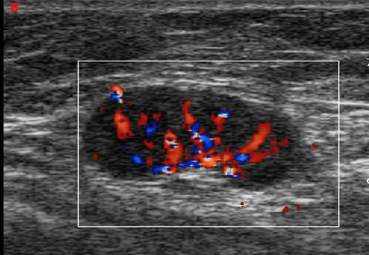 Figure 4. Lymph Node.png