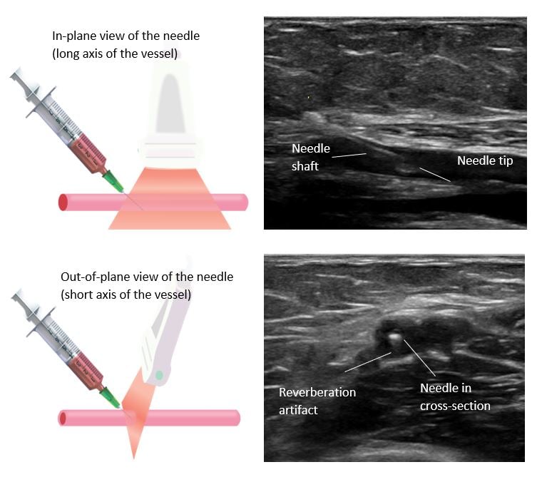 Ill 2 Short vs long axis IV Access.JPG