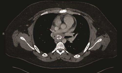 Figure 2.pdf.jpg Fibrosing mediasta