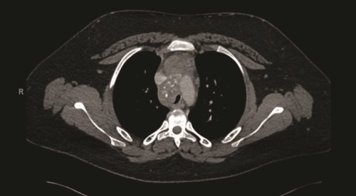 Figure 3.pdf.jpg Fibrosing mediast