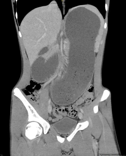 Abramo CT scan downloaded 2.jpg