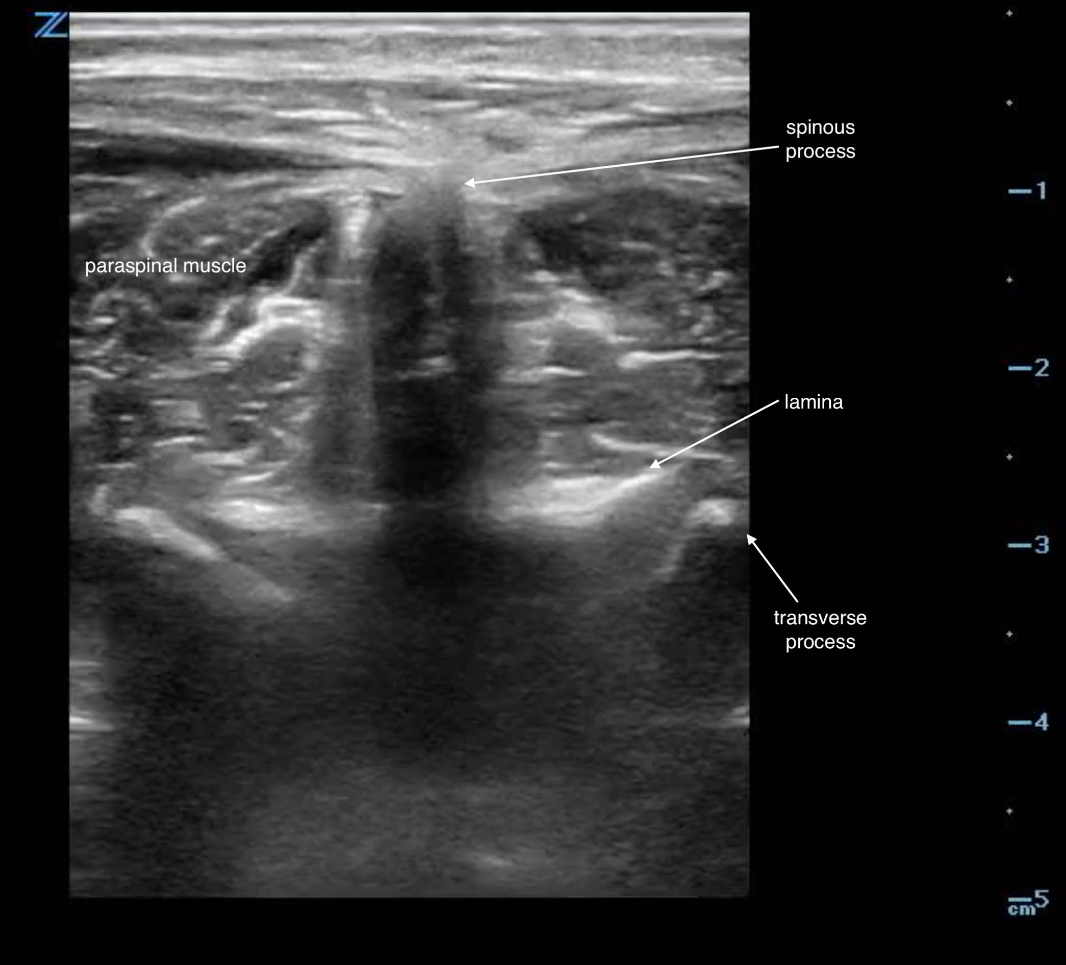 LB Figure 2. Transverse view spinous process in adult.jpg