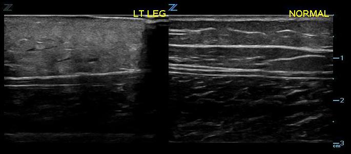 Figure 3- Early cellulitis compared with normal.jpg