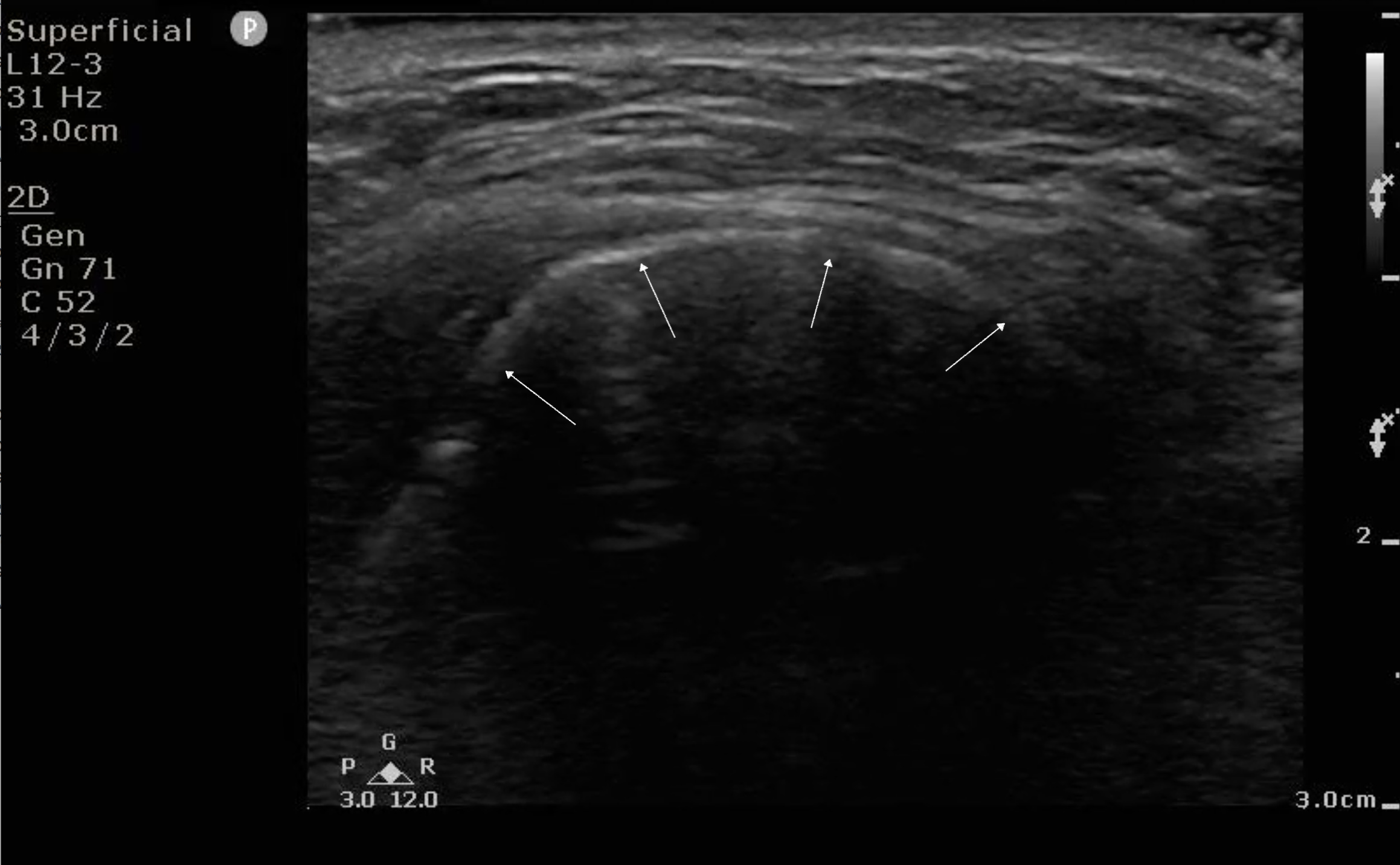 FIG 2a Image Hyoid Bone.png