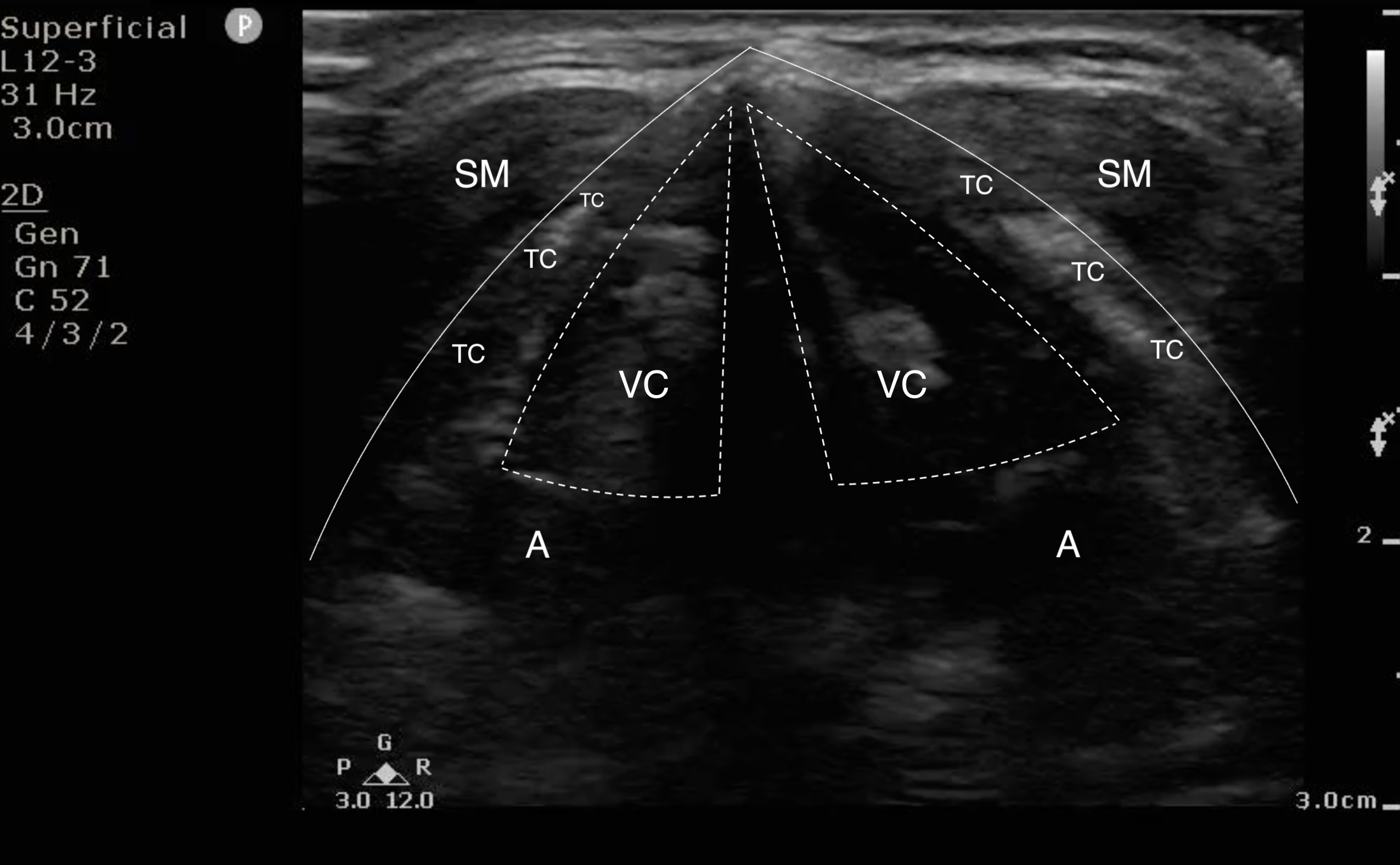 FIG 4a Image Thyroid cartilage.png