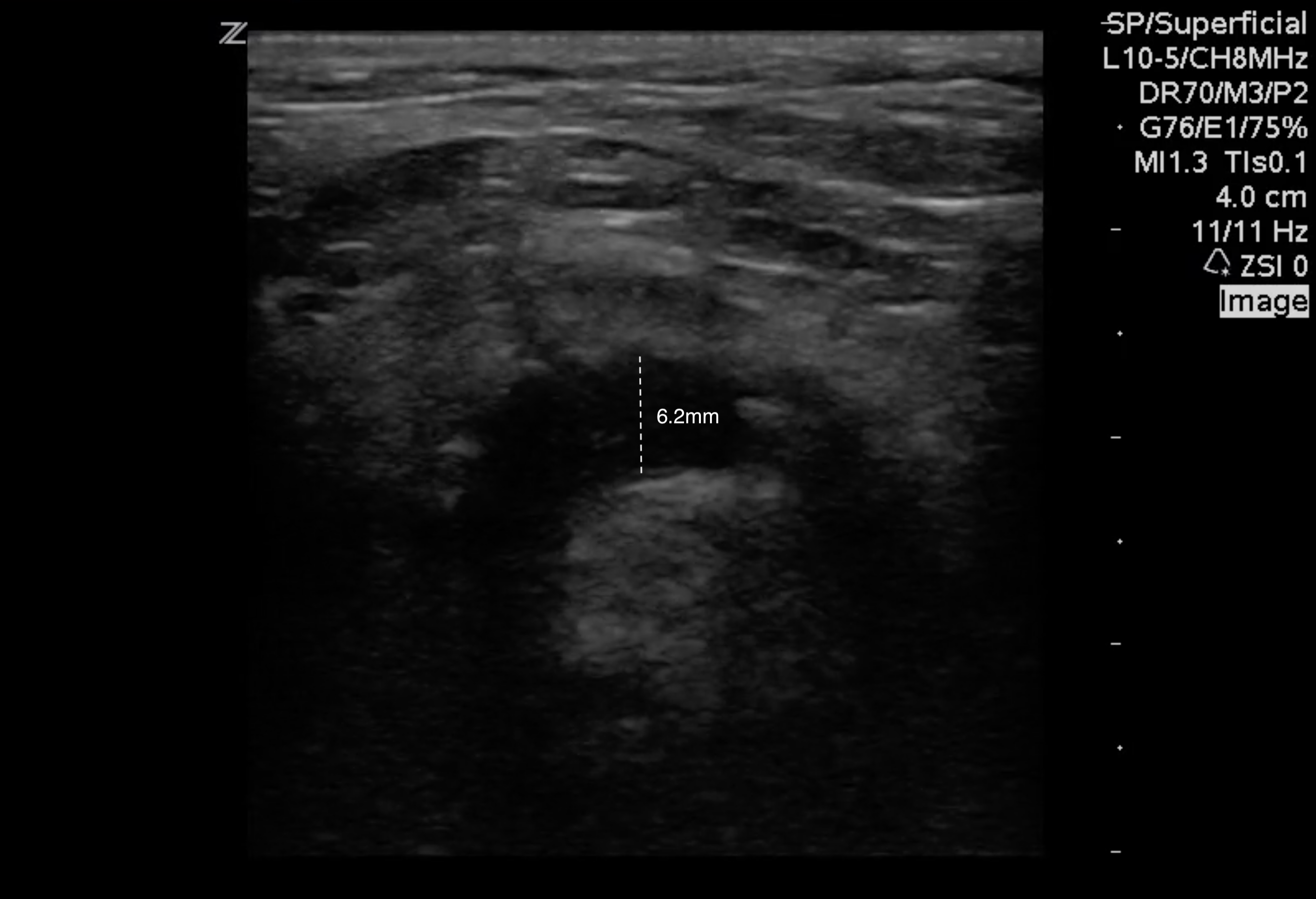 FIG 8 Epiglottitis.png