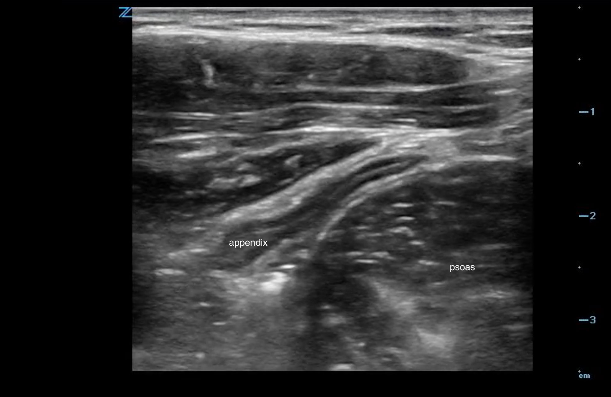 Figure 4 - hyperechoic inner band appendix.jpg