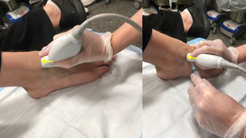 Figure 1 - Transducer placement for ankle arthrocentesis.jpg