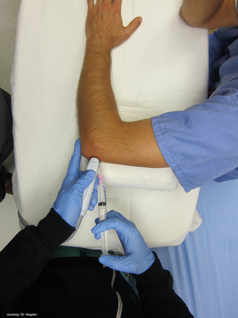 Figure 12 - Transducer placement for posterior elbow joint arthrocentesis.jpg