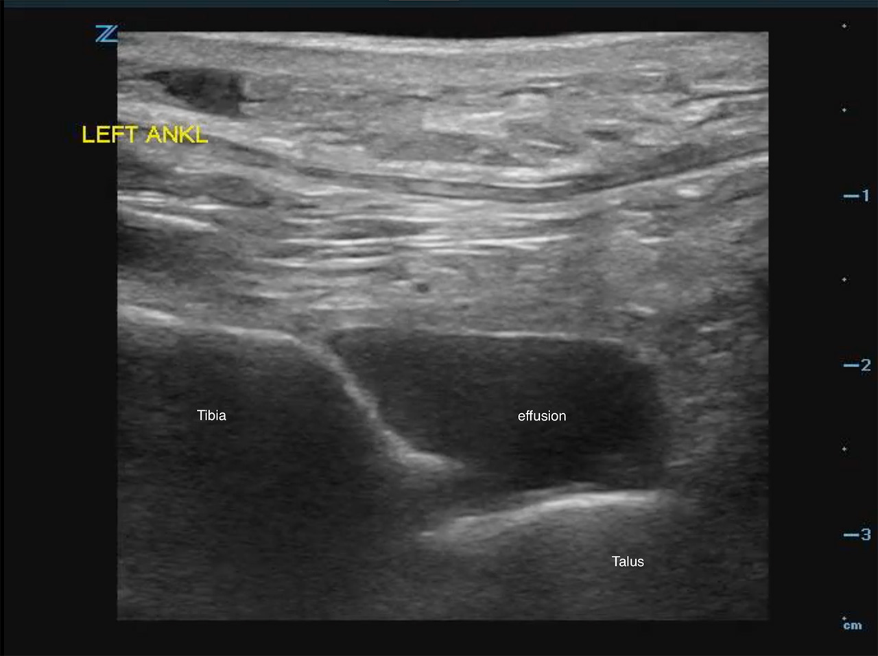 Figure 2b - US demonstrating tibiotalar effusion.jpg