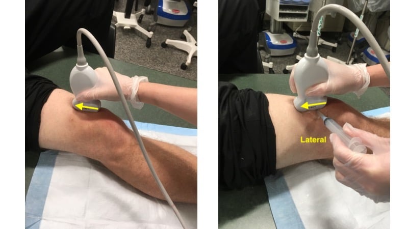 Figure 3 - Transducer Placement for knee arthrocentesis.jpg
