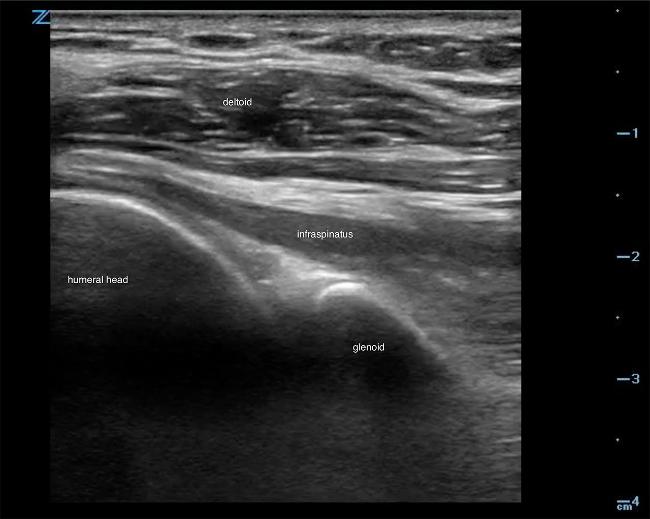 Figure 9 - US demonstrating normal shoulder.jpg