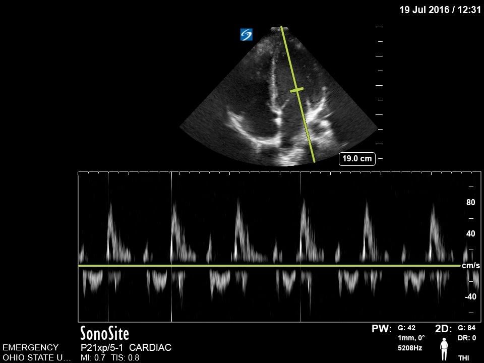 Image 14. Mitral valve inflow on pulse wave doppler.jpg