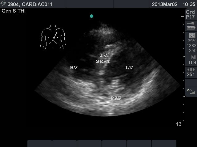 Image 3. Parasternal short axis view.jpg