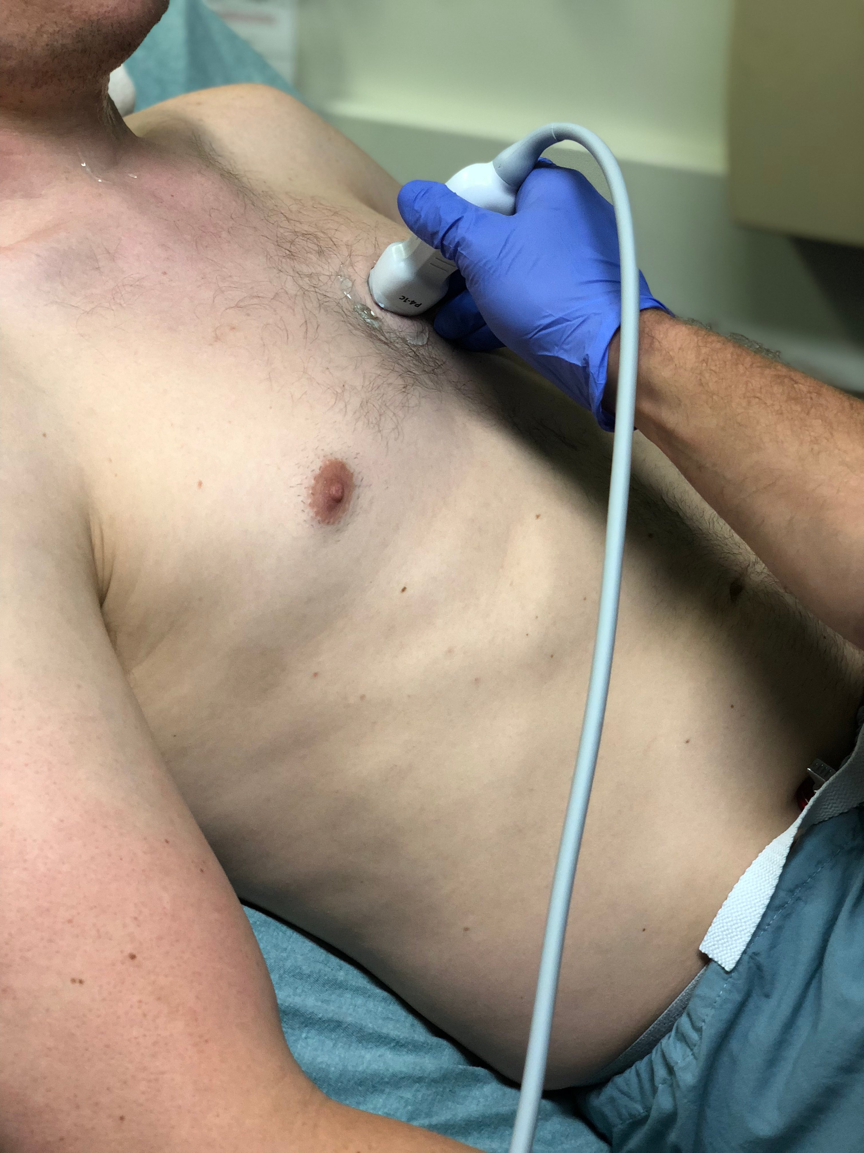 Image 8. Probe position for acquisition of parasternal long axis view.jpg