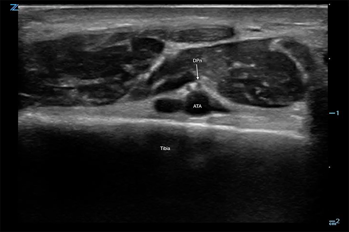 Figure 1. Deep peroneal nerve with artery.jpg