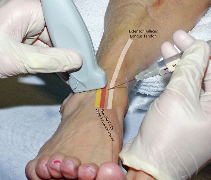 Figure 2. Hand position deep peroneal nerve block in plane.jpg