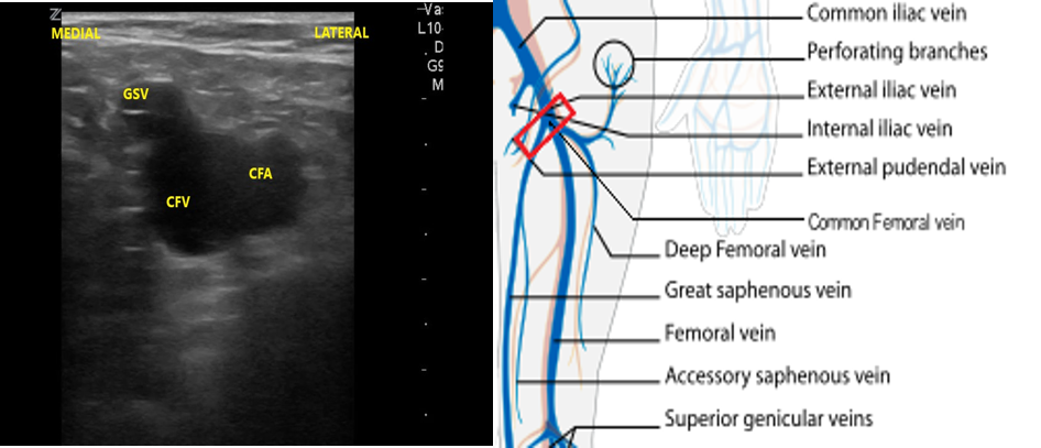 FIgure 10- CFV and GSV anatomy.png