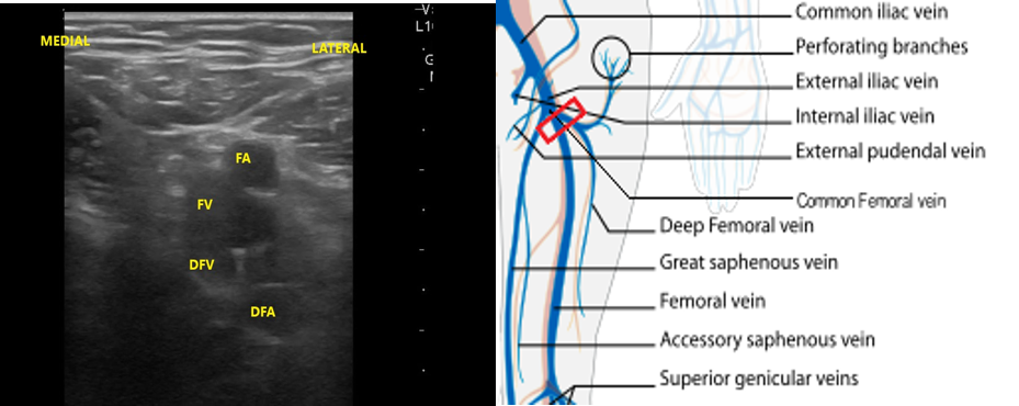 Figure 12- FV DFV anatomy.png