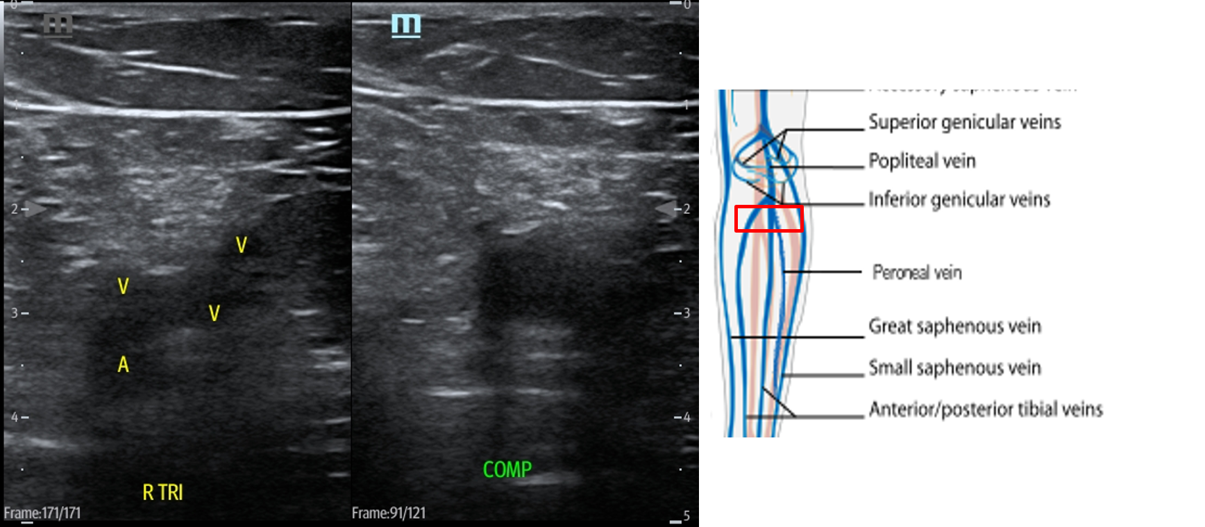 Figure 15 Trifurcation (2).png
