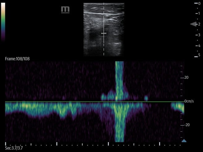 Figure 16. augmentation of calf vein .jpg