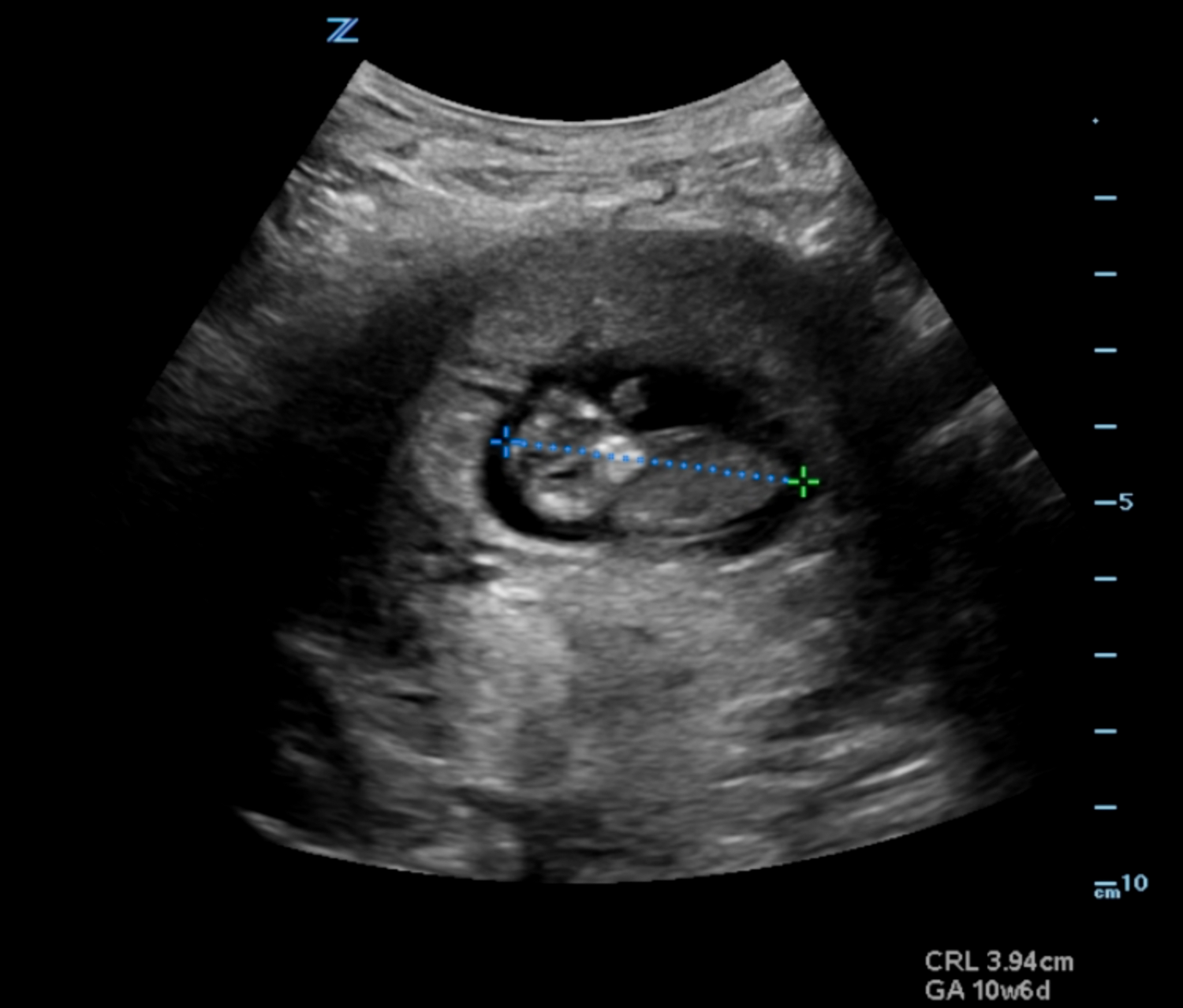Illustration 10- Crown rump length (CRL) .png