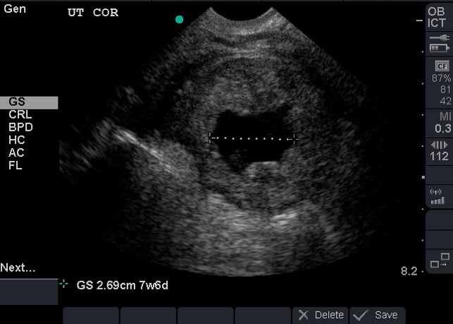 Illustration 15- Involuting gestational sac.jpg