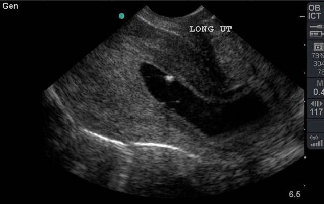 Illustration 16- Inevitable spontaneous abortion.jpg