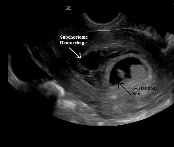 Illustration 18- Subchorionic hemorrhage.jpg