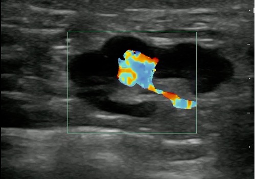 -Figure 13 - Lymph Node with Color Doppler.jpg
