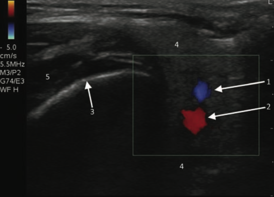 -Figure 15 - Parotid Vessels with Color doppler.png