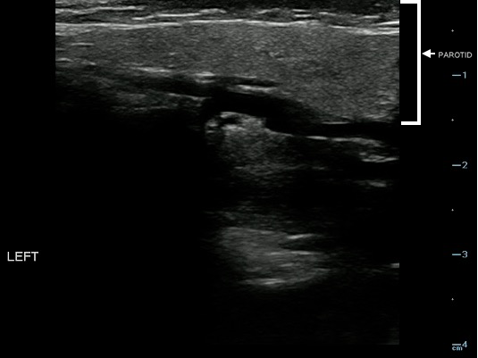 -Figure 18 - Normal Parotid.png