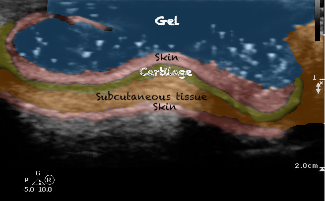 -Figure 2 - Normal Ear.png