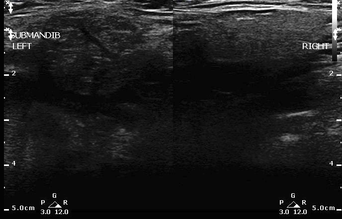 -Figure 21- Sialadenitis vs Normal.jpg
