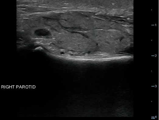 -Figure 22 - Parotitis.jpg