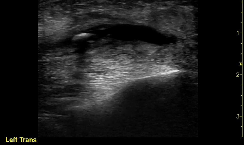 -Figure 23 - Parotitis Sialolithiasis.jpg